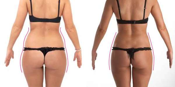 Laser Lipo
