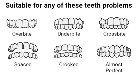 Sleeping Braces  Align your Teeth and improve your Jawline and Face Structure Step 1