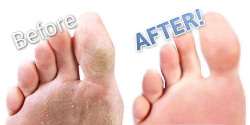 Callous Clear Foot Treatment Set
