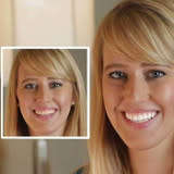 Dental Teeth Whitening Kit