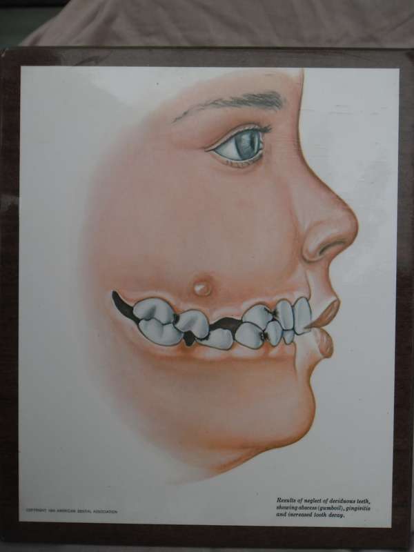 Set of 4  American Dental Association dental wall plaque displays. W R Schwartz. 1966
