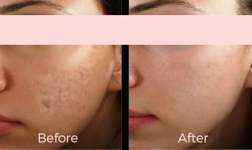 Dr Pen Ultima A6 Wireless Dermapen (Microneedling)