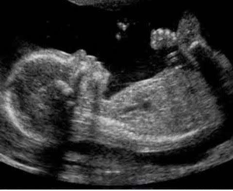 2D Fetal sonar Pregnancy package