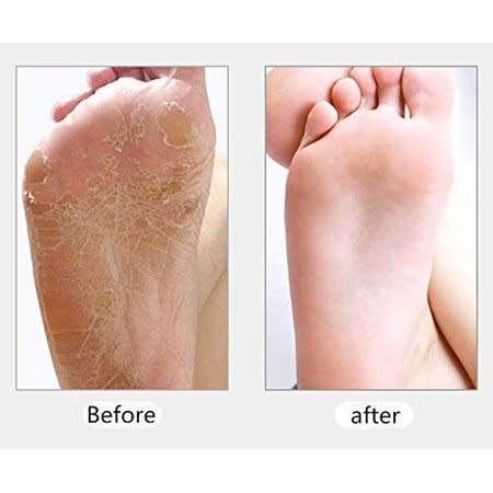 CALLUS REMOVER WITH VACUUM