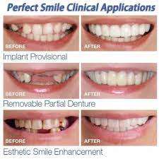 Cosmetic overlay on the upper teeth - Perfect Smile Veneers