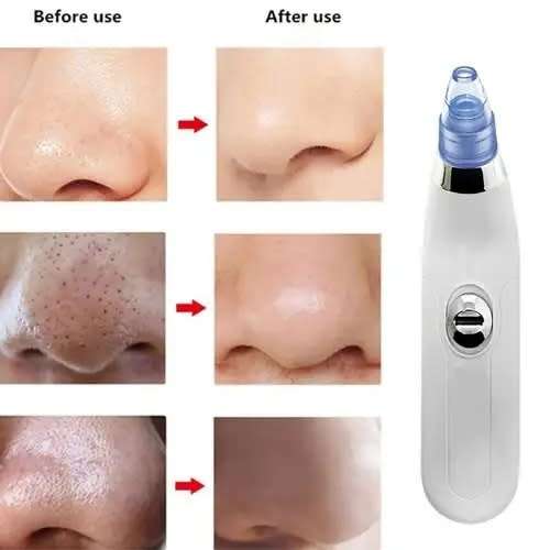 Vacuum Suction Pore cleansing device