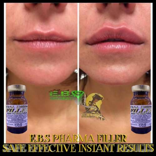 Facial FillerEbs Pharma Sa Facial Filler100 Unit Syringe