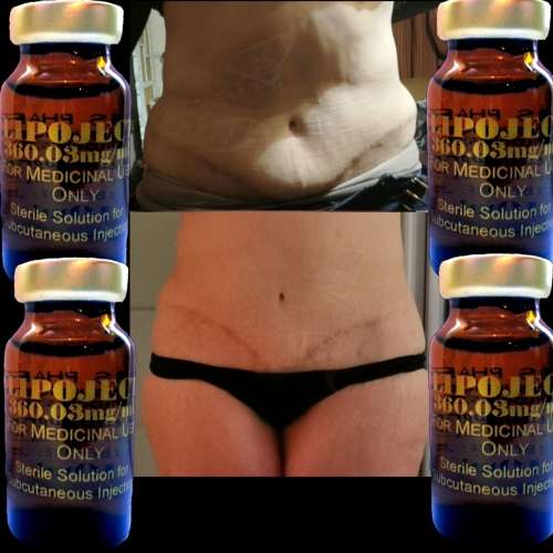 LipoLysis TreatmentEbs Pharma SaFlab To Fab Combo4x Lipojects1x Thinject