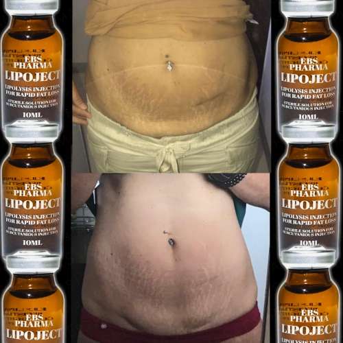 LipoLysis TreatmentEbs Pharma SaFlab To Fab Combo4x Lipojects1x Thinject
