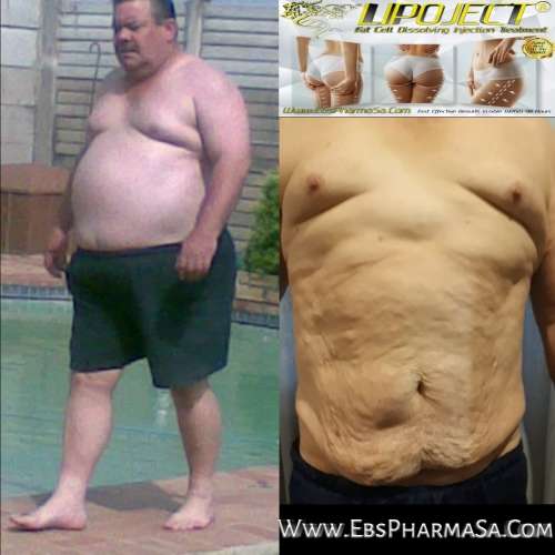 LipoLysis TreatmentEbs Pharma SaFlab To Fab Combo4x Lipojects1x Thinject