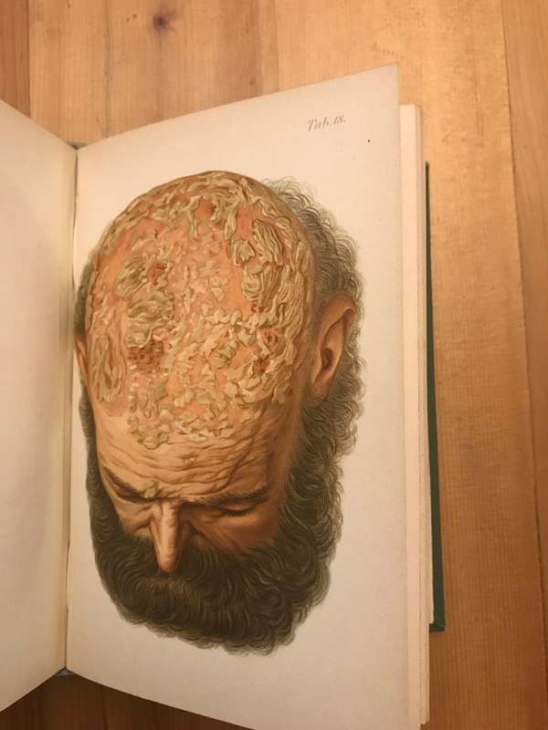 Atlas of diseases of the skin including an epitome of pathology and treatment  (Franz Mracek)