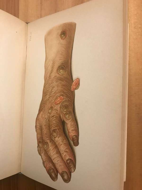 Atlas of diseases of the skin including an epitome of pathology and treatment  (Franz Mracek)