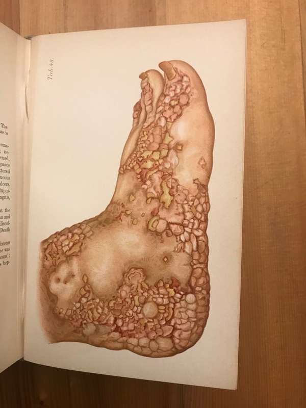 Atlas of diseases of the skin including an epitome of pathology and treatment  (Franz Mracek)