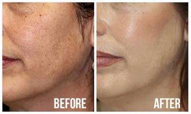 GlutaWhite Skin whitening brightening X 30 1500000 mg. Glutathione V-face lightening tightening