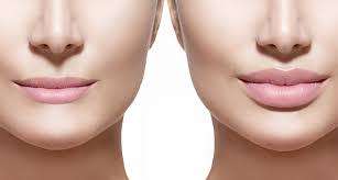 Special! Juvederm Dermal filler 2 x 1ml. Hyaluronic acid gel 24ml/ml Original. Made in France
