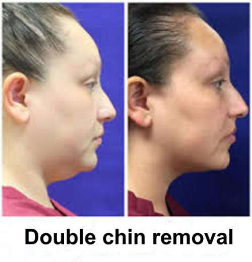 30 caps. Nano Glutathione+Q10 Whitening 1500000 mcg,Double chin gone V-line Skin tightening Slimming