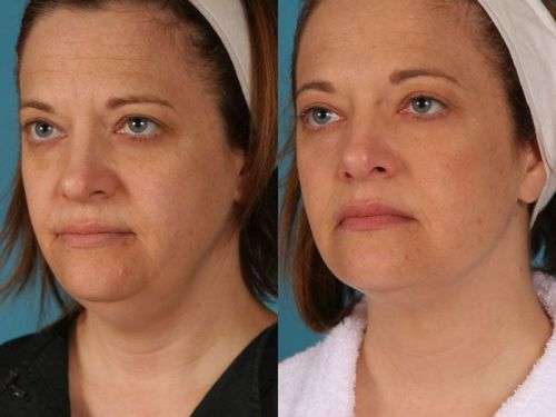 1pcs 2N V-face mask. 1cm Lifting in 1 treatment.Whitening,reduction double chin,skin tightening