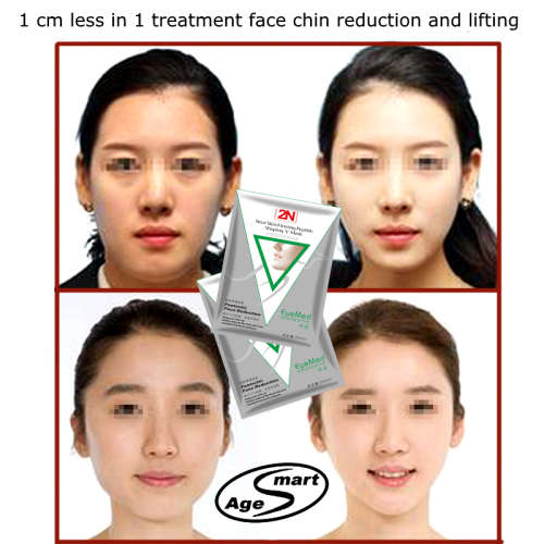1pcs 2N V-face mask. 1cm Lifting in 1 treatment.Whitening,reduction double chin,skin tightening