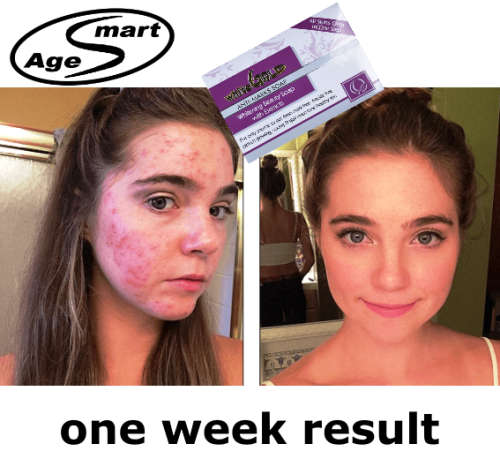 100g Anti-marks soap.sun block white gold.Aloe, anti-aging,skin whitening.thitening in 3 min