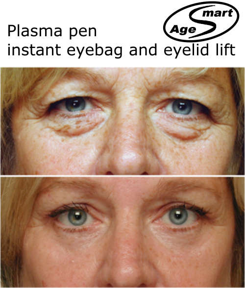 Instant plasma eyelid lift,scars,wart,spot,acne,eyebags,wrinkles.Same High tech Plasma pen as PlexR.