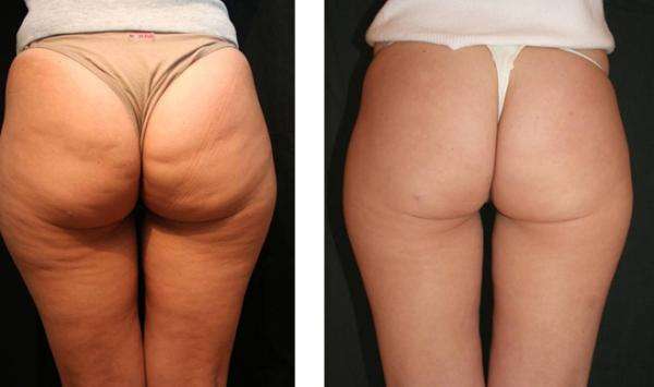 Cellulite gel cream 150ml.Lift hips and buttoks. Break fat slimming firming sculpting stretch mark