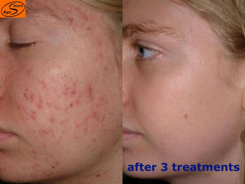 R300 picosecond laser skin spot removal warts freckles scars,acne tattoosJHB only NOT DEVICE.