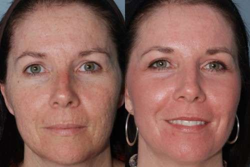 R300 picosecond laser skin spot removal warts freckles scars,acne tattoosJHB only NOT DEVICE.