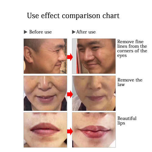 Hyaluron dermal pen/gun no needle face skin filler 0.3ml+8 joint+hyaluronic acid 10 vials anti-aging