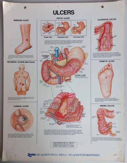 Vintage school poster - Ulcers