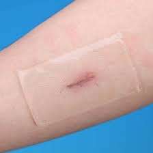 Silicone scar sheets