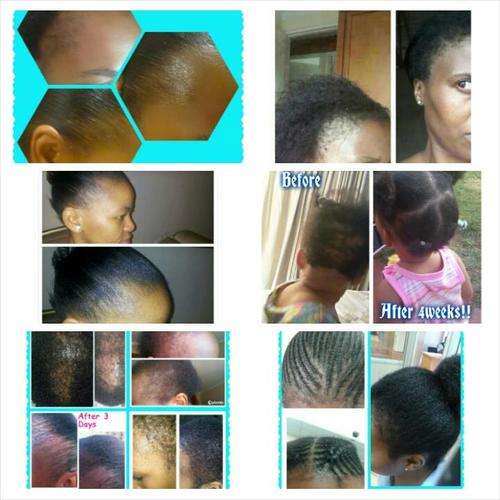 ETHNIC HAIR LOSS ? - 2 BOTTLES FOR R350 - PEANIE HAIR GROWTH TONIC !!!!