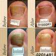Low Level Laser Therapy units- Increases Your Blood Flow and Regenerates New Cells