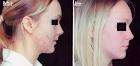LLLT- Hair Loss-Wrinkles-Cellulite-Pain Relief-Tissue Repair-Acne Scars-Anti Inflammatory