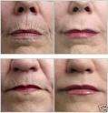 LLLT- Low Level Laser Therapy-  Laser Energy