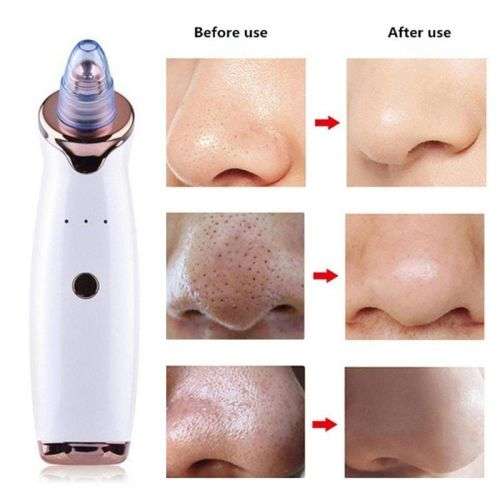 Dermabrasion Blackhead Removal Handset