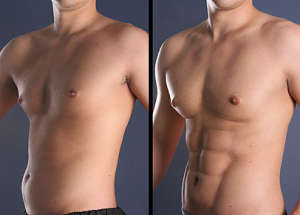 Laser Lipo x 4 Sessions at Brazen Beauty Bar - Randburg, Johannesburg