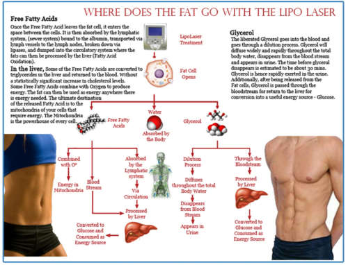 Laser Lipo x 4 Sessions at Brazen Beauty Bar - Randburg, Johannesburg