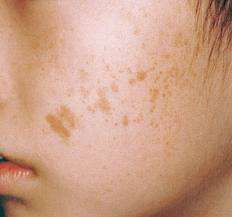Vibrant Life Miracle Range  Clear your skin of unsightly marks and blemishes,