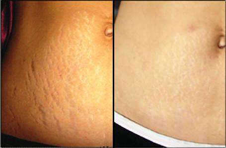 * 70% STRENGTH GLYCOLIC PEEL LOW PH FOR FOR STRECHMARKS *