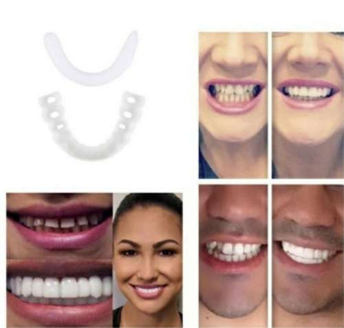 Instant snap on smile mold