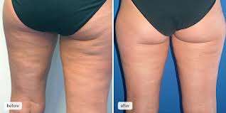 Start your own on invasive lipo and rejuvenation clinic