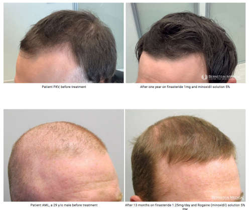 Rogaine x1 month