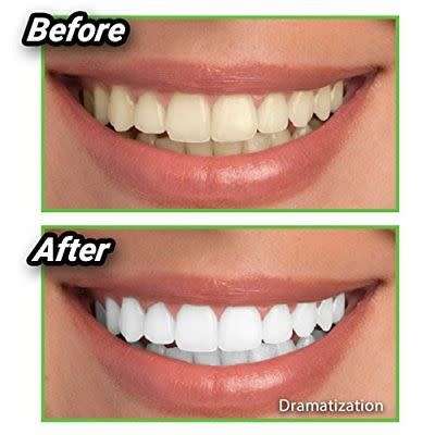 Miracle Teeth Whitener