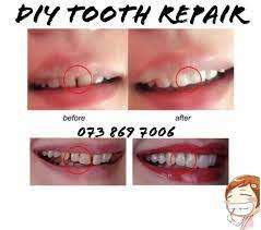 Tooth Repair - GAP DiY Temporary FILLERS - Large Pack
