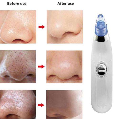 Derma Suction Facial Pore Cleaner - Dark Spot, Black Head and Acne Remover