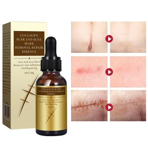 Pei Mei  Collagen  Acne Scar , Burn Scar , Injury Scar and Stretch Marks Repair and Removal Essence