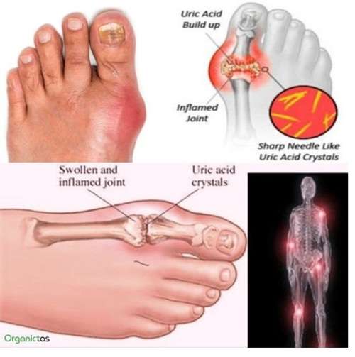 Chinese Herbal Tea For Gout and Arthritis - 20 Servings