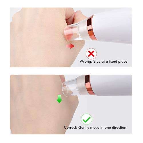 Blackhead Remover