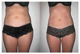 Lose 5 - 23 cm's of total body fat per hour !! Get ready for summer NOW!!