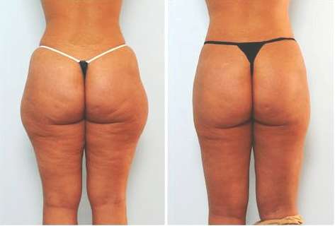 Lose 5 - 23 cm's of total body fat per hour !! Get ready for summer NOW!!